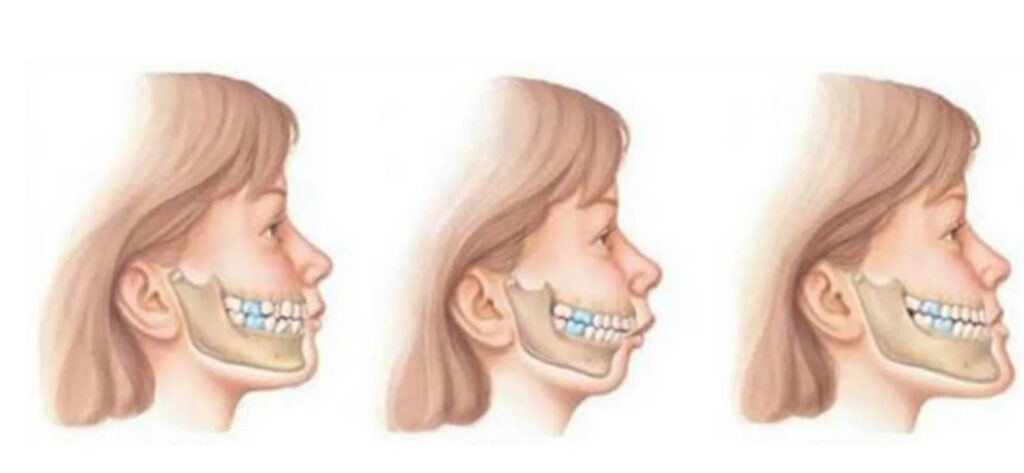 错颌畸形的几种类型